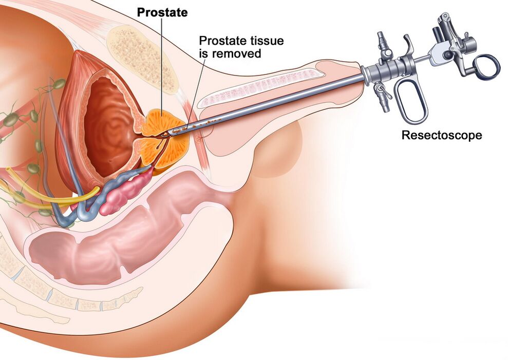 Colectarea de țesut de prostată pentru diagnosticul precis al prostatitei