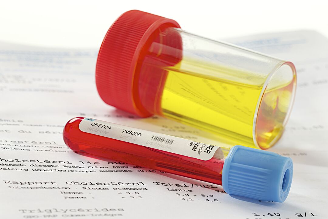 Un test de sânge și urină va ajuta la determinarea prezenței prostatitei. 