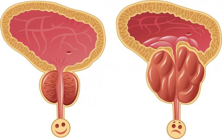 Prostată sănătoasă și prostatită