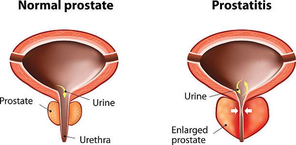 prostata normala si inflamata