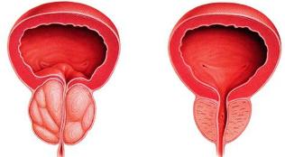 diferența bolnav și sănătos de prostată